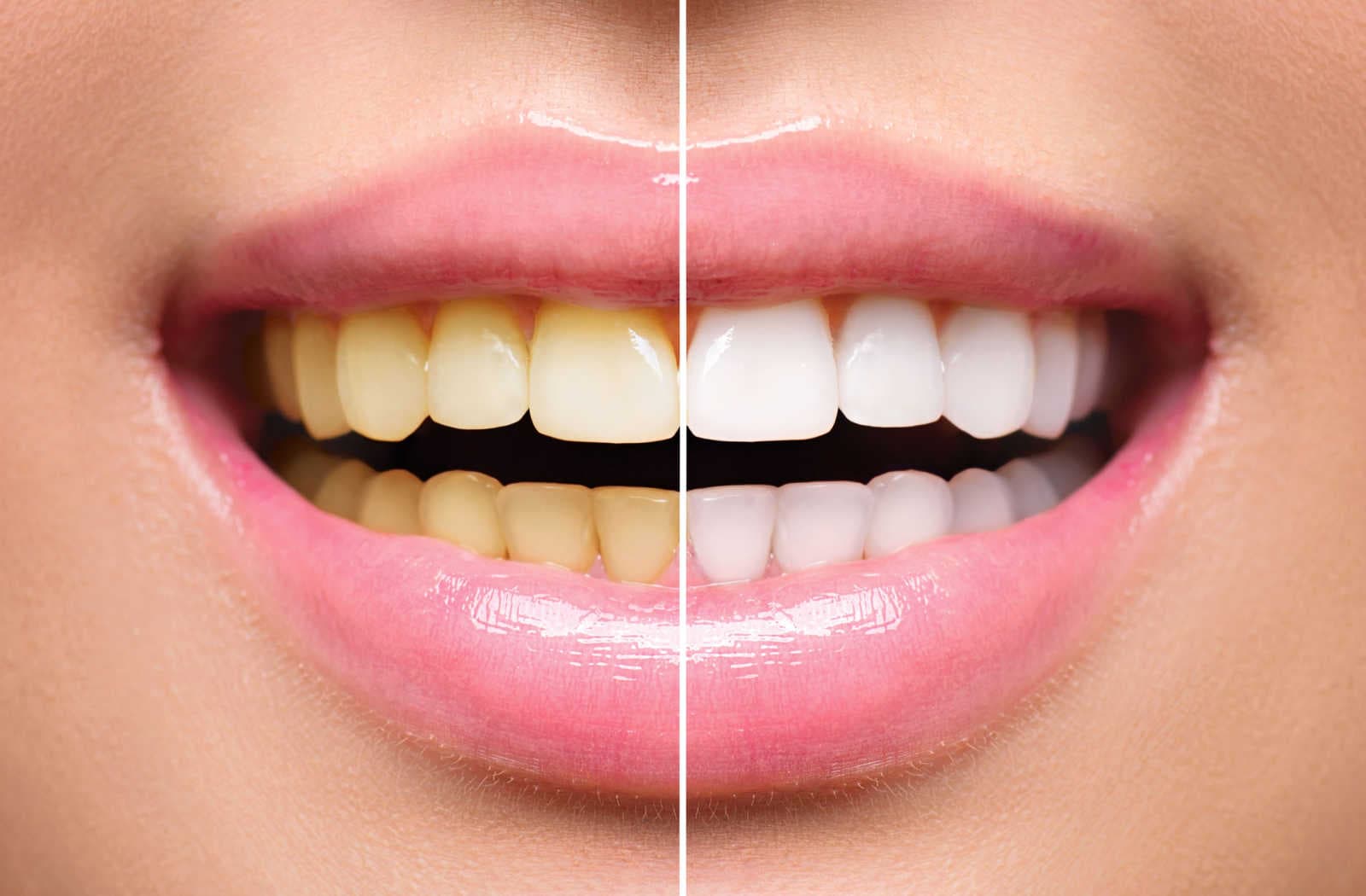 yellow-vs-white-teeth-comparison-01.jpg (86 KB)